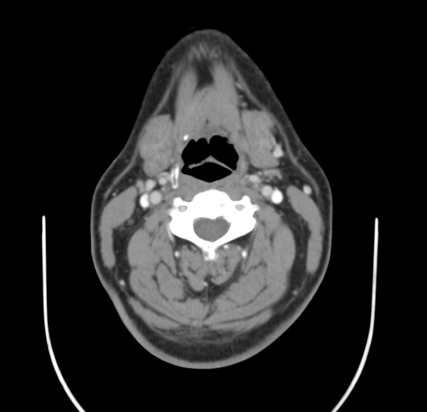 Colloid cyst of thyroid (Radiopaedia 22897-22923 Axial C+ delayed 36).jpg