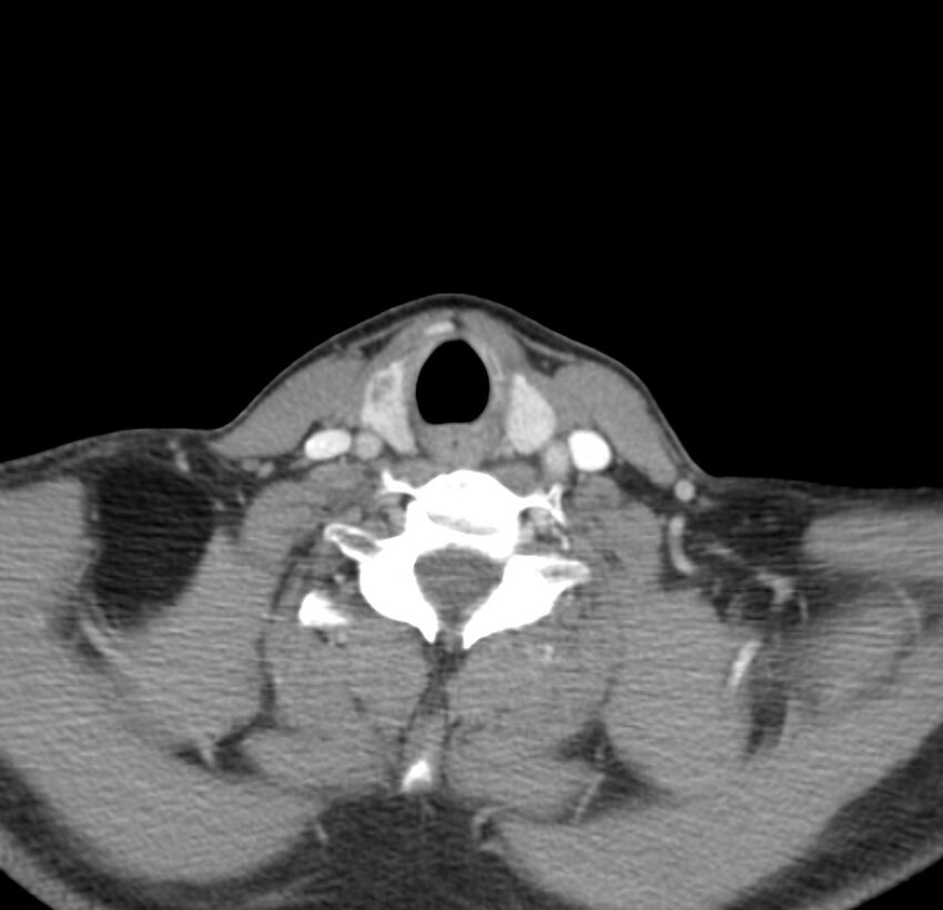 Colloid cyst of thyroid (Radiopaedia 22897-22923 Axial C+ delayed 57).jpg