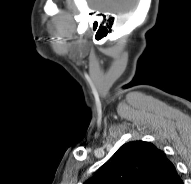File:Colloid cyst of thyroid (Radiopaedia 22897-22923 Sagittal C+ delayed 50).jpg