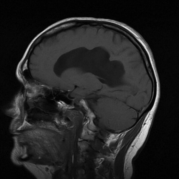 File:Colloid cyst with hydrocephalus (Radiopaedia 9373-10065 Sagittal T1 7).jpg