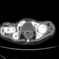 Colocolic fistula - Crohn disease (Radiopaedia 57063-63955 A 91).jpg