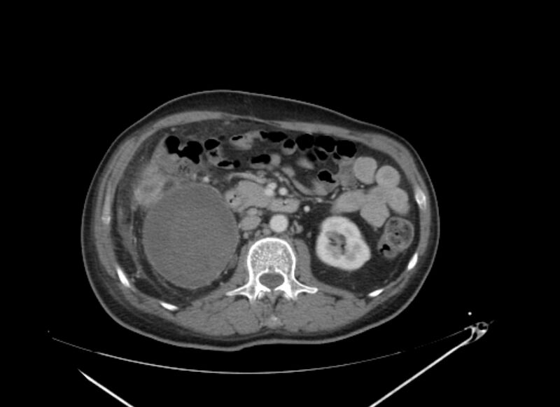 File:Colon cancer mimicking renal cell carcinoma (Radiopaedia 28986-29335 C 33).jpg