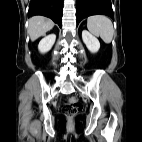 File:Colon carcinoma with hepatic metastases (Radiopaedia 29477-29961 B 32).jpg