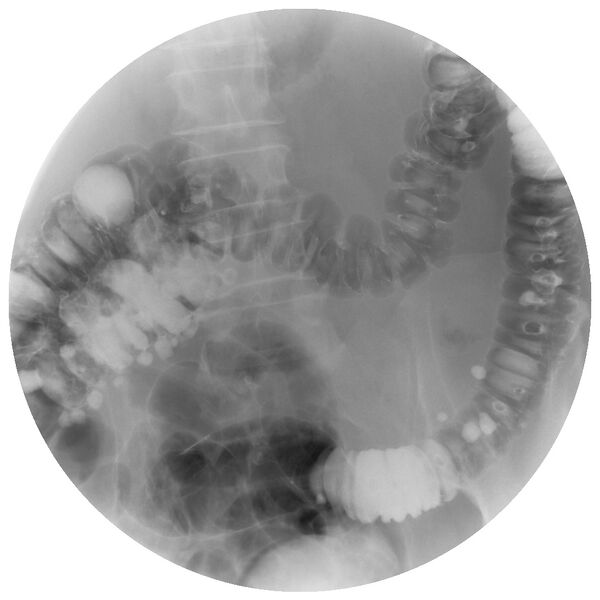 File:Colonic diverticulosis on single and double contrast barium enema (Radiopaedia 42254-45340 Double contrast 2).jpg