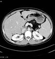 Cystic fibrosis with cirrhosis and pancreatic atrophy (Radiopaedia 6673).jpg