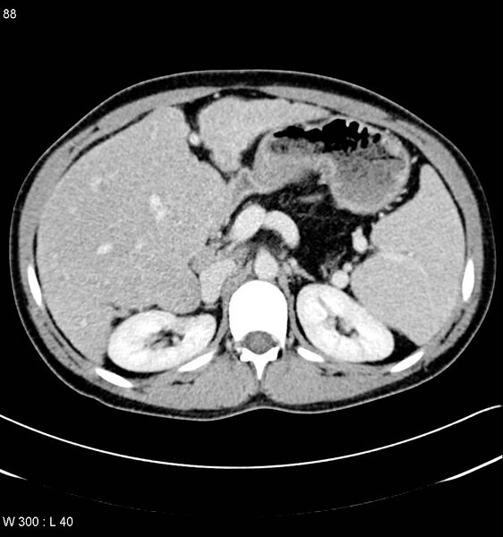 File:Cystic fibrosis with cirrhosis and pancreatic atrophy (Radiopaedia 6673).jpg