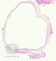 pathology-Urachal cyst