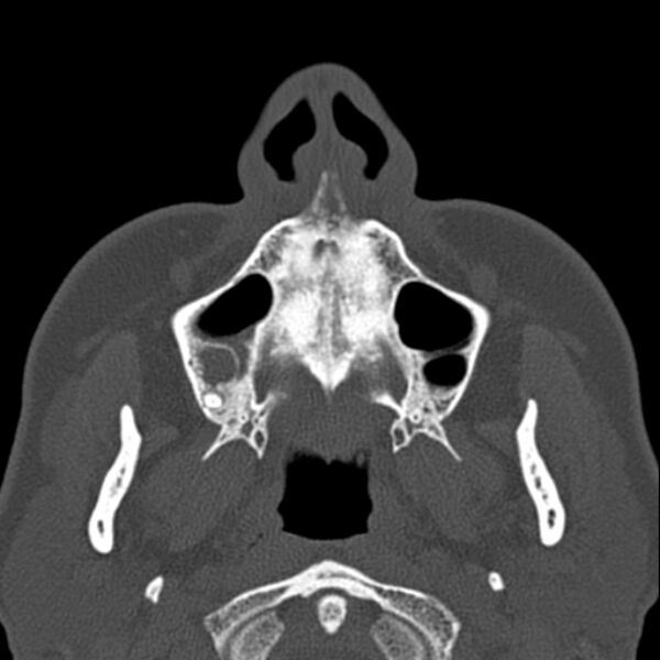 File:Nasal septal perforation (Radiopaedia 25030-25289 Axial bone window 3).jpg