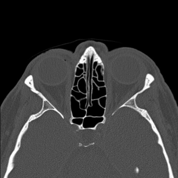 File:Nasal septal perforation (Radiopaedia 25030-25289 Axial bone window 42).jpg