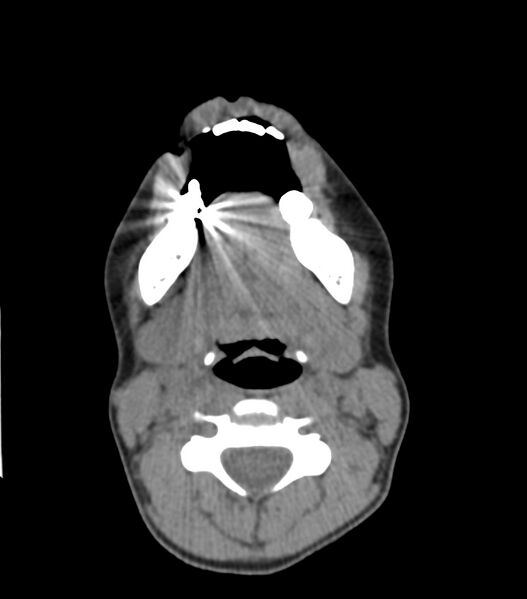 File:Nasoorbitoethmoid fracture (Radiopaedia 90044-107205 Axial non-contrast 60).jpg