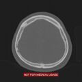 Nasopharyngeal carcinoma recurrence - skull base destruction (Radiopaedia 29107-29490 Axial bone window 23).jpg