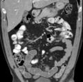 Necrotizing pancreatitis with acute necrotic collection (Radiopaedia 14470-14417 C 11).jpg