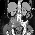 Nerve sheath tumor - malignant - sacrum (Radiopaedia 5219-6987 B 10).jpg