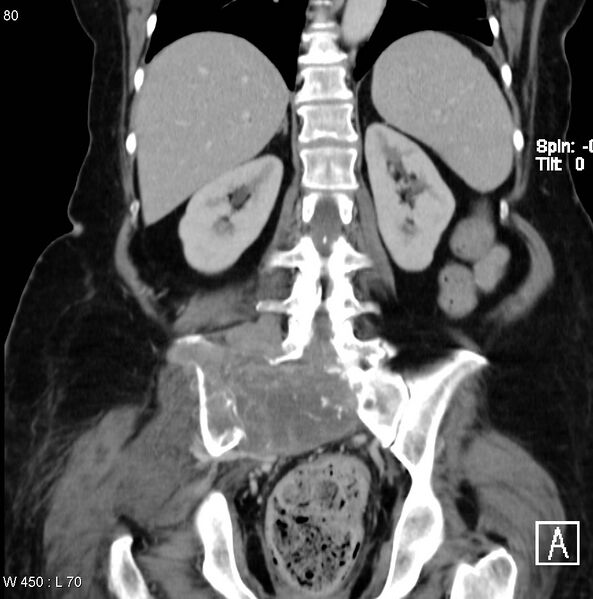 File:Nerve sheath tumor - malignant - sacrum (Radiopaedia 5219-6987 B 10).jpg