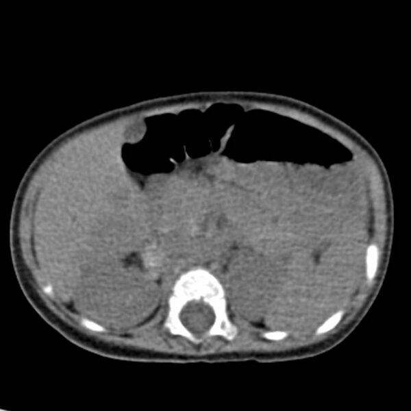 File:Neuroblastoma with skull metastases (Radiopaedia 30326-30960 Axial non-contrast 22).jpg