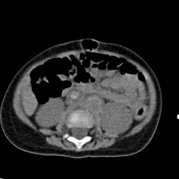 File:Neuroblastoma with skull metastases (Radiopaedia 30326-30960 Axial non-contrast 34).jpg
