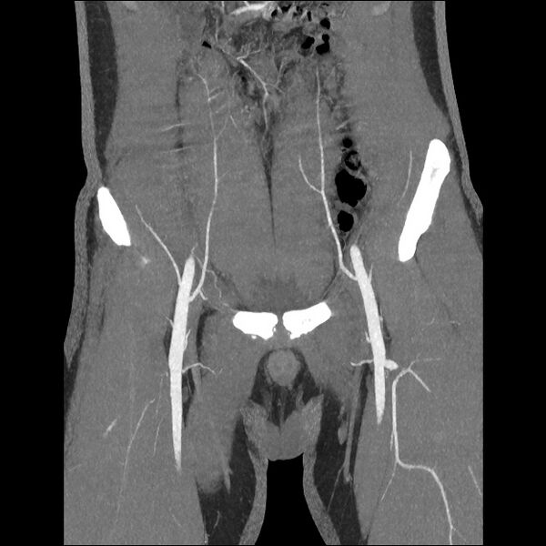 File:Normal CT angiogram of pelvis (Radiopaedia 45390-49430 B 16).jpg