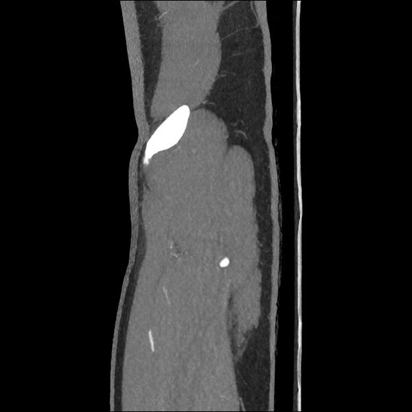 File:Normal CT angiogram of pelvis (Radiopaedia 45390-49430 C 8).jpg