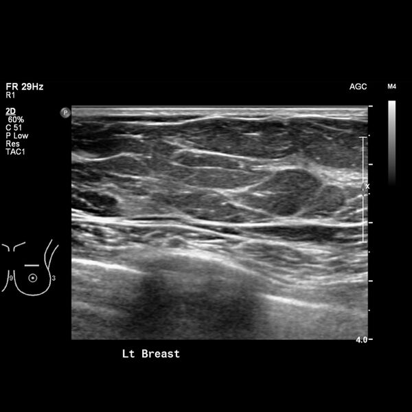 File:Normal breast mammography (tomosynthesis) and ultrasound (Radiopaedia 65325-74354 Left breast 2).jpeg
