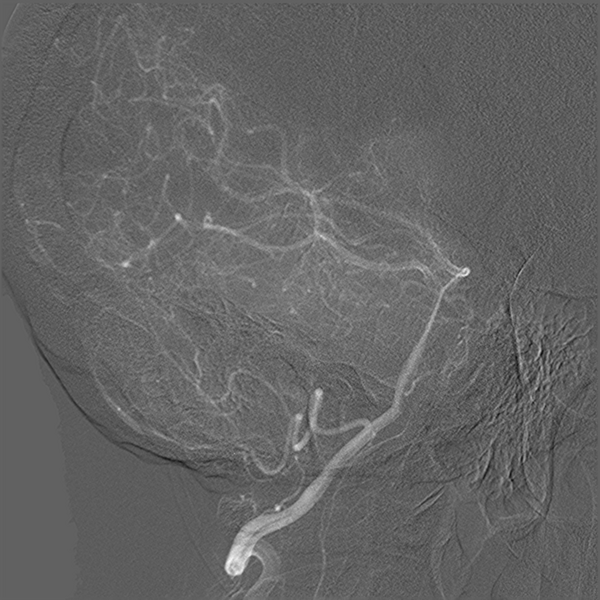 File:Normal cerebral angiogram (four vessel DSA) (Radiopaedia 41708-44649 O 11).png