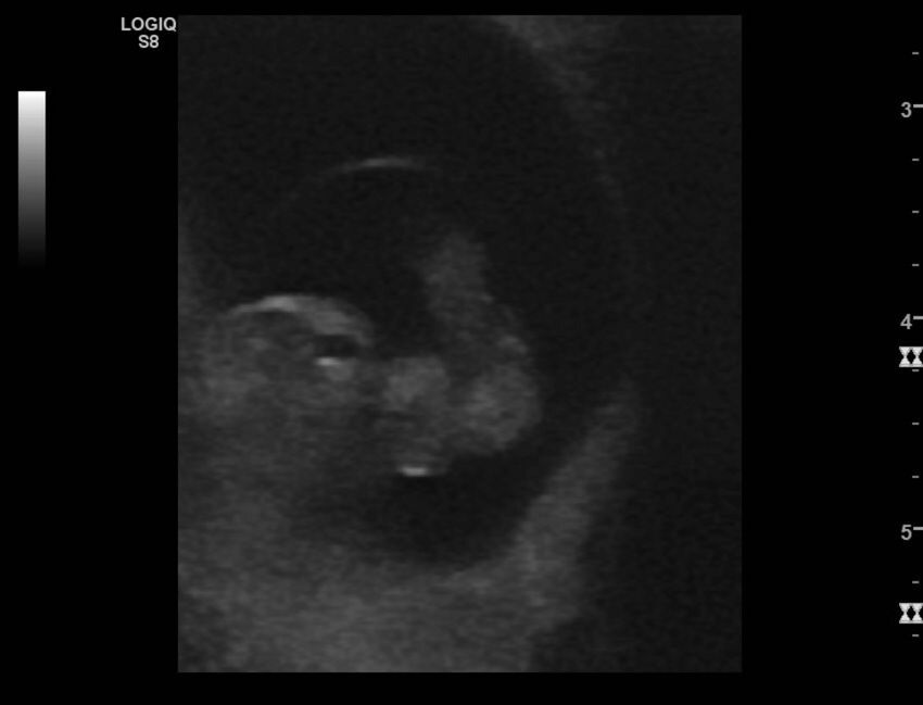 Normal early pregnancy - 8w0d (Radiopaedia 44715-48492 Longitudinal 50).jpg