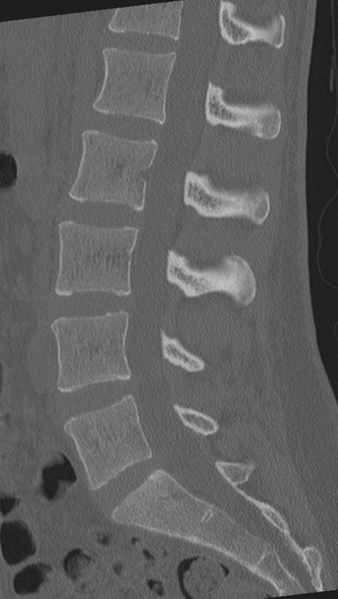 File:Normal lumbar spine CT (Radiopaedia 46533-50986 Sagittal bone window 54).png