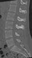 Normal lumbar spine CT (Radiopaedia 46533-50986 Sagittal bone window 54).png