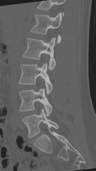 File:Normal lumbar spine CT (Radiopaedia 46533-50986 Sagittal bone window 61).png