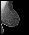Normal mammography (low density breasts) (Radiopaedia 77169-89175 D 1).jpg