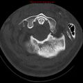 Occipital condyle fracture (Radiopaedia 18366-18208 Axial bone window 15).jpg