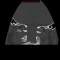 Occipital condyle fracture (Radiopaedia 18366-18208 Coronal bone window 17).jpg