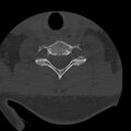 Occipital condyle fracture (Radiopaedia 31755-32691 Axial bone window 59).jpg