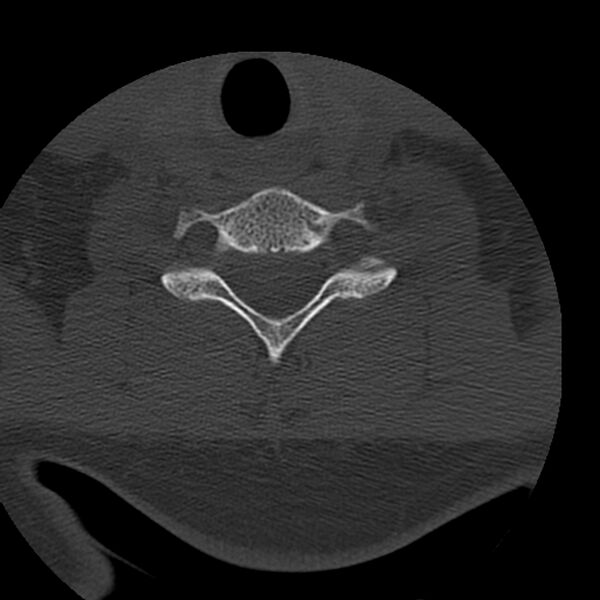 File:Occipital condyle fracture (Radiopaedia 31755-32691 Axial bone window 59).jpg