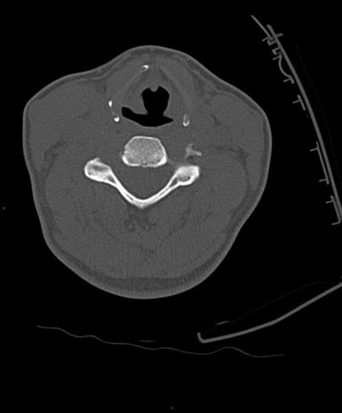 File:Occipital condyle fracture (Radiopaedia 61165-69056 D 17).jpg