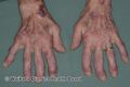 Rheumatoid arthritis (DermNet NZ rheumatoid-hands).jpg