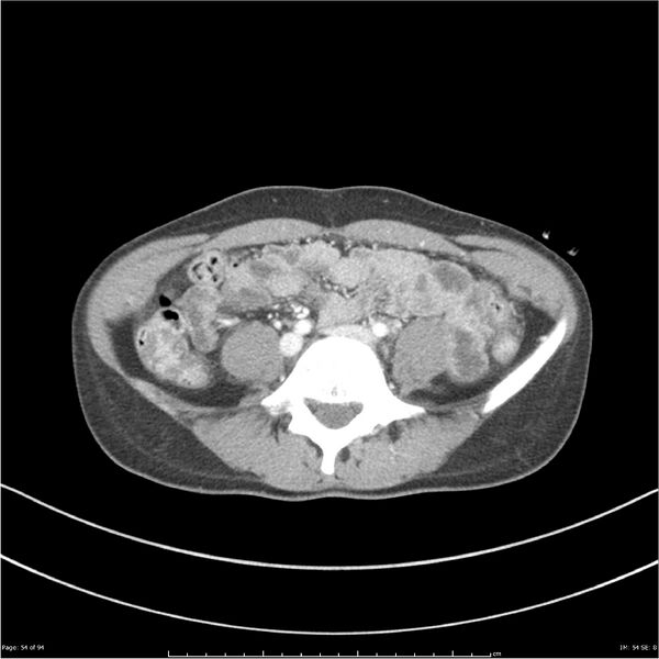 File:Traumatic renal artery dissection and pancreatic transection (Radiopaedia 37061-38739 Axial 218).jpg