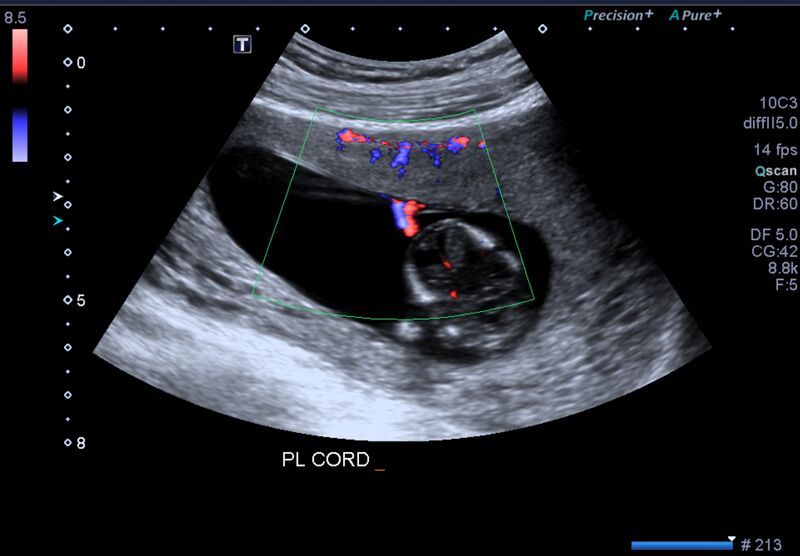 File:1st trimester nuchal-morphology ultrasound (Radiopaedia 44706-48477 General anatomy and NT 43).jpg