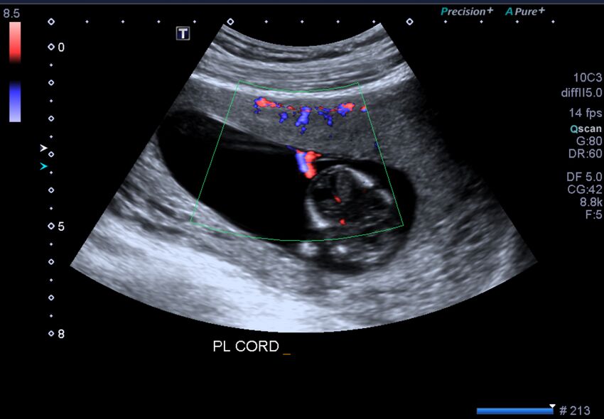 1st trimester nuchal-morphology ultrasound (Radiopaedia 44706-48477 General anatomy and NT 43).jpg