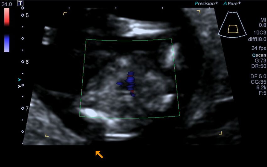 1st trimester nuchal-morphology ultrasound (Radiopaedia 44706-48477 Heart views cine with colour 179).jpg