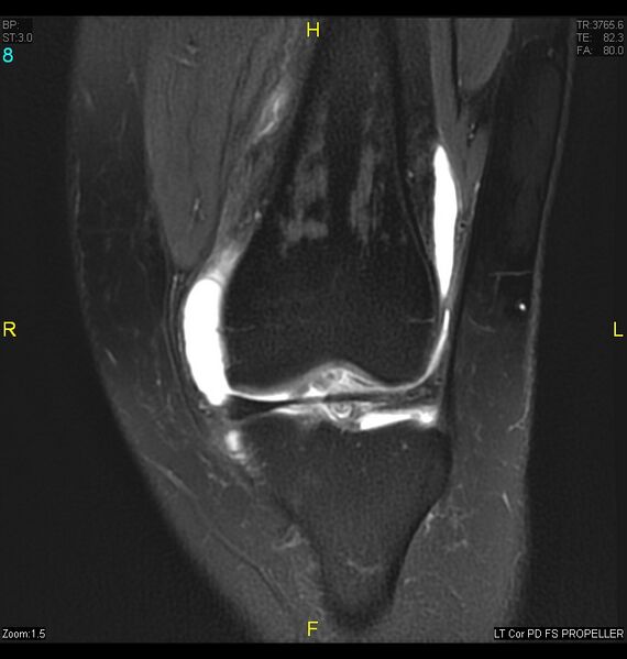 File:ACL mucoid degeration with cystic changes (Radiopaedia 48428-53341 Coronal PD fat sat 5).jpg