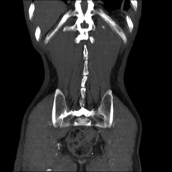 File:Abdominal aortic aneurysm (Radiopaedia 23703-23856 Coronal C+ arterial phase 32).jpg