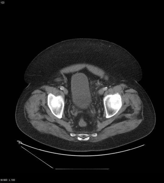 File:Abdominal aortic aneurysm with intramural hematoma then rupture (Radiopaedia 50278-55631 Axial C+ arterial phase 113).jpg