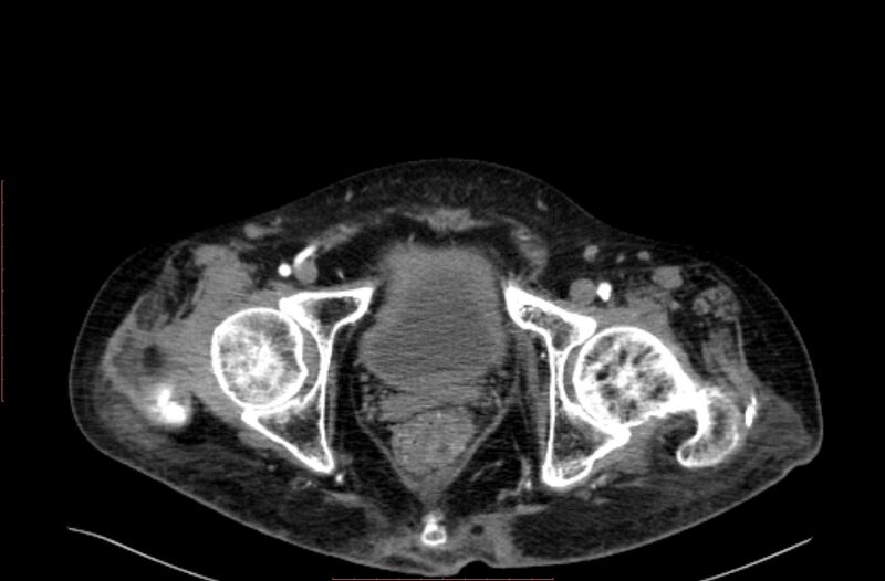 File:Abdominal aortic interposition tube graft and aneurysm thrombosis (Radiopaedia 71438-81857 Axial C+ arterial phase 234).jpg