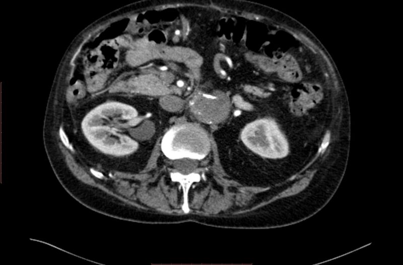 File:Abdominal aortic interposition tube graft and aneurysm thrombosis (Radiopaedia 71438-81857 Axial C+ arterial phase 52).jpg