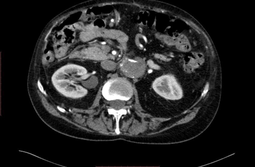 Abdominal aortic interposition tube graft and aneurysm thrombosis (Radiopaedia 71438-81857 Axial C+ arterial phase 52).jpg