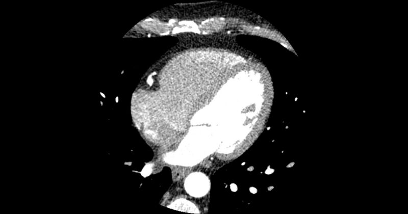 File:Aberrant left main coronary artery (ALMCA) arising from the right sinus with interarterial course (Radiopaedia 63251-71814 Axial C+ arterial phase 116).JPG