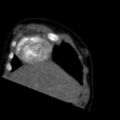 Aberrant left pulmonary artery (pulmonary sling) (Radiopaedia 42323-45435 Coronal C+ CTPA 24).jpg