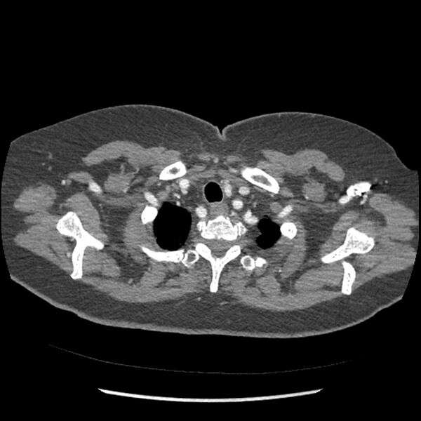 File:Aberrant right subclavian and left vertebral arteries (Radiopaedia 43467-46847 Axial C+ portal venous phase 11).jpg