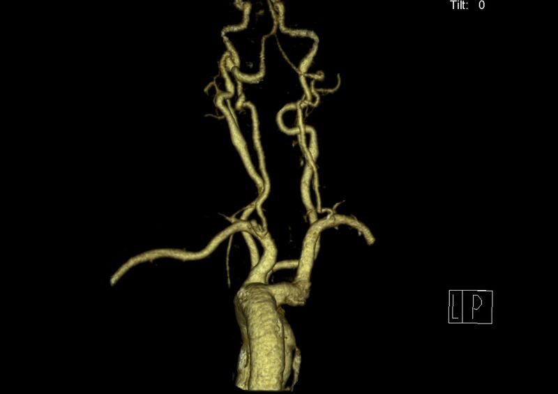 File:Aberrant right subclavian artery (Radiopaedia 19283-19294 3D reconstruction C+ arterial phase 20).jpg