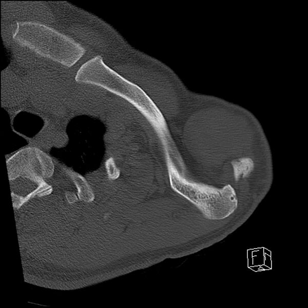 File:Acromioclavicular joint dissociation - type IV (Radiopaedia 64411-73216 Axial bone window 9).jpg